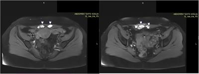 Surgical management of abdominal wall sheath and rectus abdominis muscle endometriosis: a case report and literature review